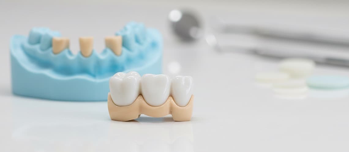 Professional Dental Bridges procedure at Prime Dental - serving Baldwin Park, El Monte, La Crescenta, and 5 more LA County cities