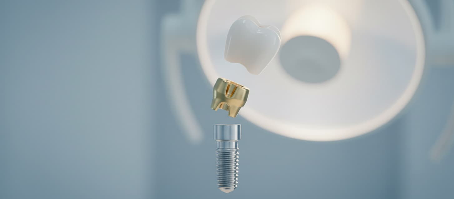 Implantes Dentales - Prime Dental