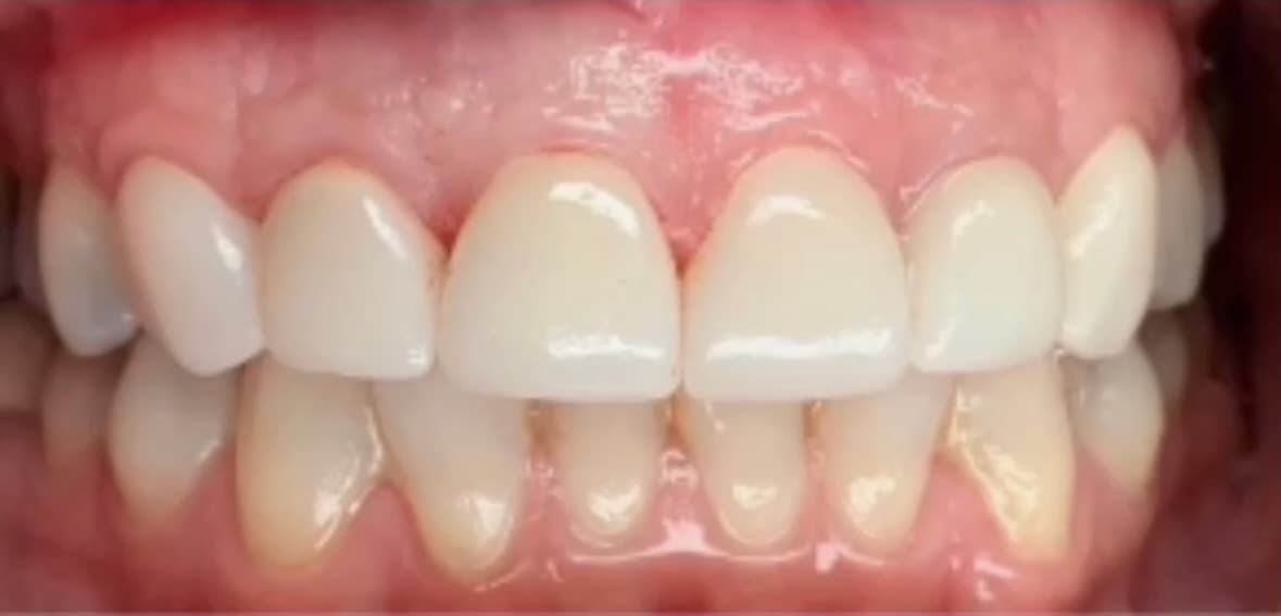 Después del tratamiento de Carillas de Porcelana en Baldwin Park, El Monte, La Crescenta, y 5 ciudades más del Condado de LA - diente restaurado de aspecto natural en Prime Dental