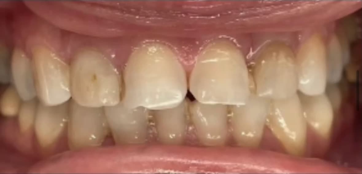Before Porcelain Dental Veneers treatment in Baldwin Park, El Monte, La Crescenta, and 5 more LA County cities - Before Veneers